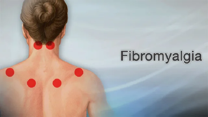 Fibromyalgia